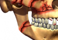 Fracturas maxilares