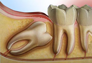 Cirugía de terceros molares (muelas del juicio)